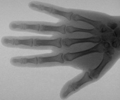 Немецкий физик Вильгельм Конрад Рентген открыл «рентгеновские лучи»